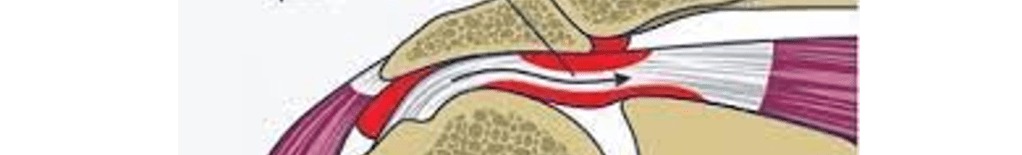 Pinzamiento / Tendinitis / Bursitis en el hombro