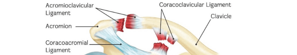 Luxación acromioclavicular